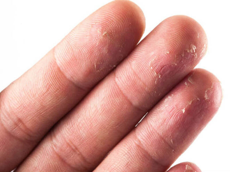 Khóa cửa không nhận dấu vân tay do tay có vết trầy xước, bong tróc không hiện rõ vân tay